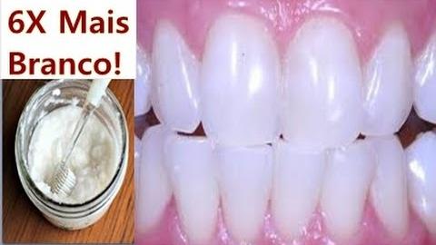 Dentes Brancos NA HORA – Tirar Tártaro e Acabar Com Gengivite 100% Natural