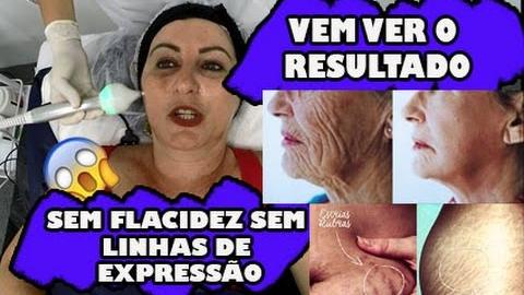 Descubra como PREVENIR E RECUPERAR a ELASTICIDADE com RADIOFREQUÊNCIA
