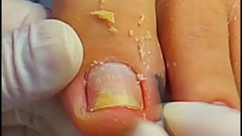 Podóloga Luana Caldin tratando micoses nas unhas