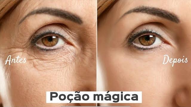 Tira rugas e pés de galinha – Tratamento para sua pele