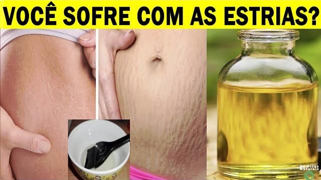 7 Truques Infalíveis Para Dizer Adeus às Estrias