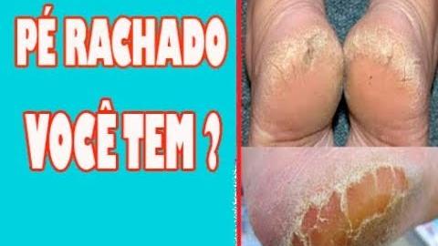 Receita Para Pés Rachado – Com 2 Ingredientes