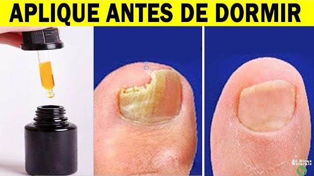 SÓ 3 Gotas Deste Óleo Para Eliminar os FUNGOS DAS UNHAS em Poucos Dias