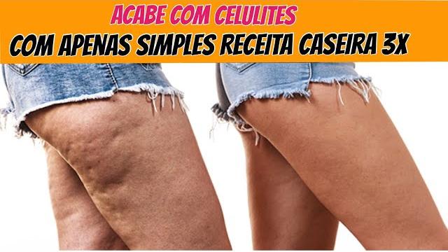 Melhore as Celulites com esta Simples Receita Caseira