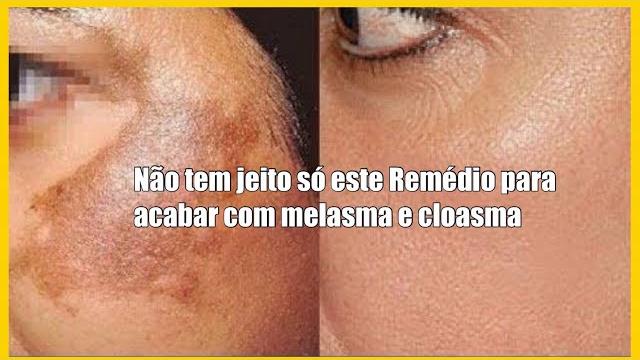 Uma Dica Para Você que Quer Acabar Com Manchas DE Melasma e Cloasma