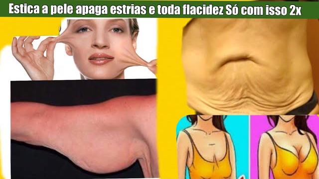 Estica a Pele e Apaga as Estrias e Toda a Flacidez – Essa eu Indico
