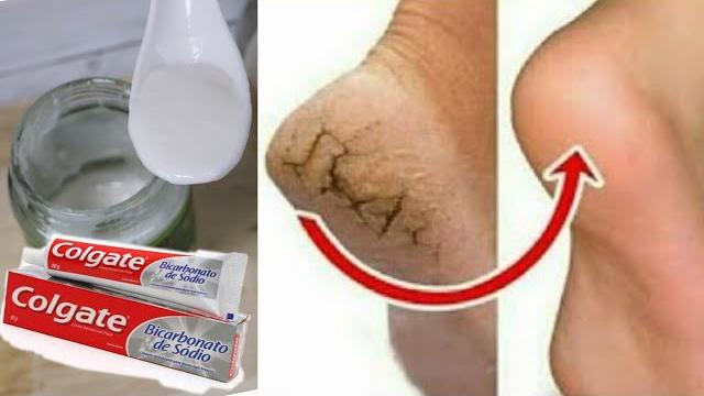 Como Acabar com as Rachadura dos Pés