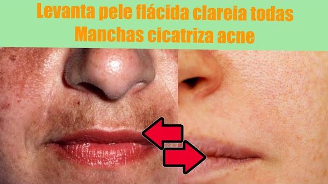 Mascara Fácil Para Tirar Manchas de Espinha e Clarear a Pele