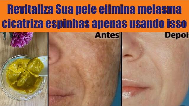 Use Isso para Revitalizar Sua Pele, Eliminar Manchas de Melasma e Cicatrizar Espinhas