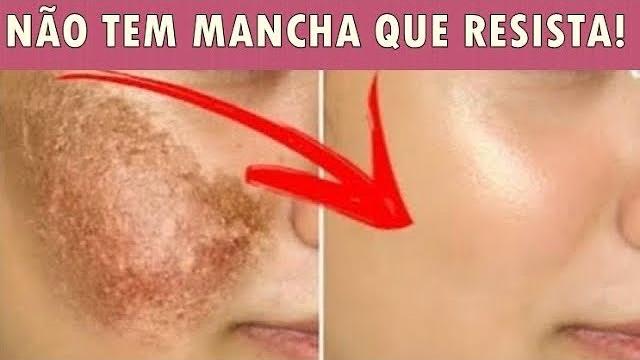 Adeus Manchas de Melasma e Rugas – Clareia manchas e Estimula o colágeno