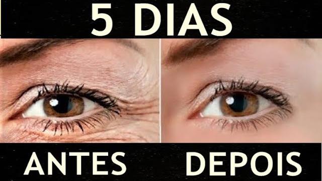 Como Retirar Olheiras E Inchaço Nos Olhos