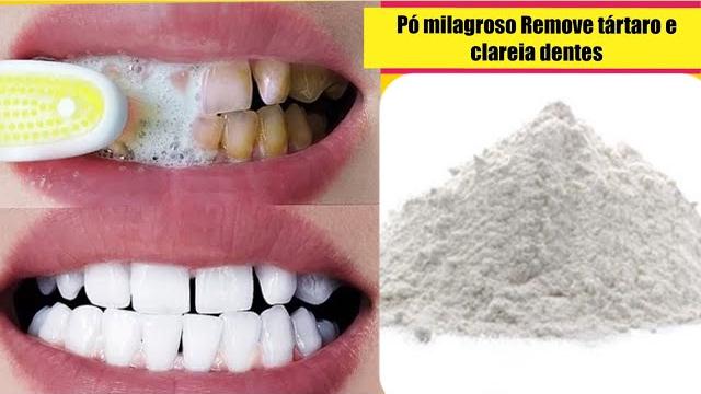 Descubra Como Remover Tártaro E Clarear Os Dente