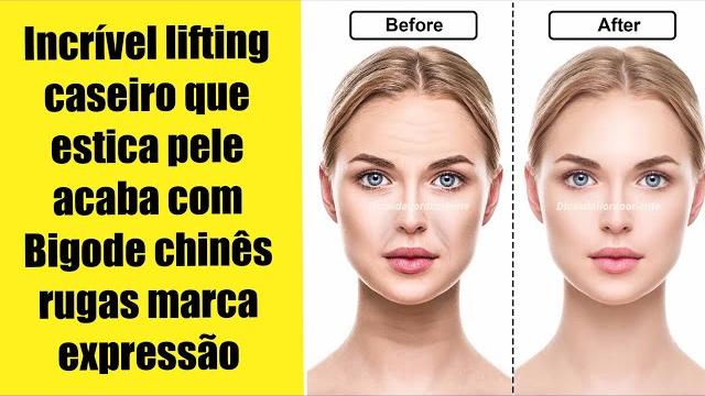 Lifting Caseiro Para A Marca De Expressão