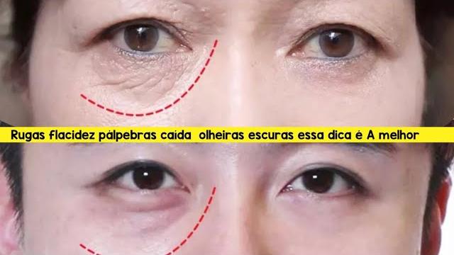 Creme Para Levantar As Pálpebras, Diminuir Rugas E Flacidez