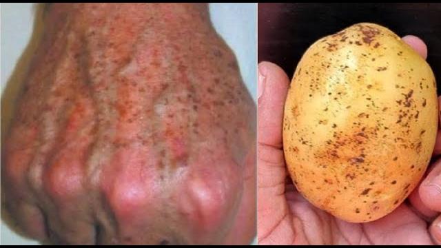 Ótima Dica Caseira para Tratar as Rugas