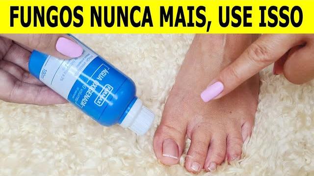 Nunca Mais Tenha Fungos e Micose nas Unhas – Super Receita Caseira